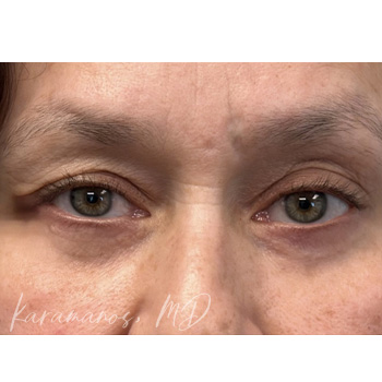 Blepharoplasty After