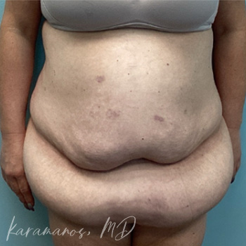 Abdominoplasty Before