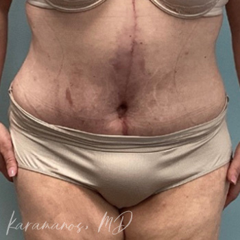 Abdominoplasty After