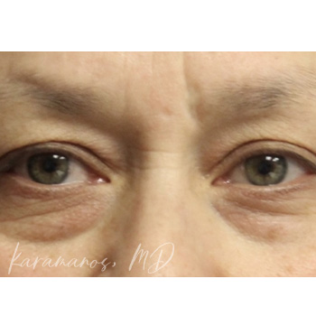 Blepharoplasty Before